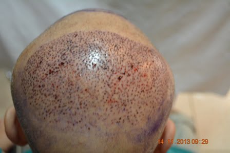 Crown area hair transplantation