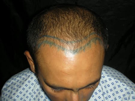 Hair transplant in Los Angeles