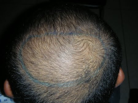 California hair transplant