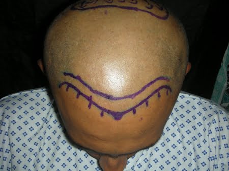 Frontal hairline design photo