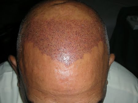 fue hair transplant photo north carolina