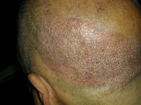 Hair transplantation north carolina photo