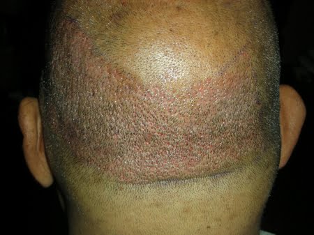 Hair transplant in North carolina photo