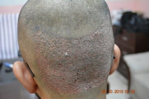 Donor area after Fue procedure