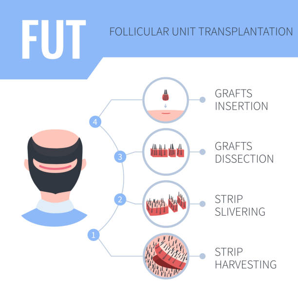 FUT surgery steps