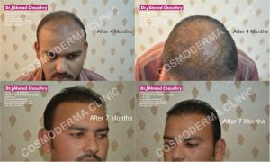 Follicular unit transplant Pakistan