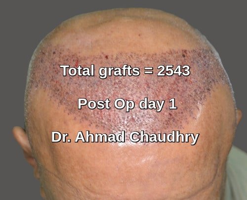 Fue 2543 grafts Mashhad patient