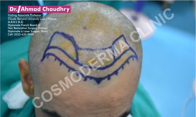 Fue hair transplant Mian Channu Khanewal