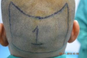 Fue hair transplant Vehari
