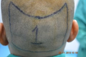 Fue hair transplant Vehari