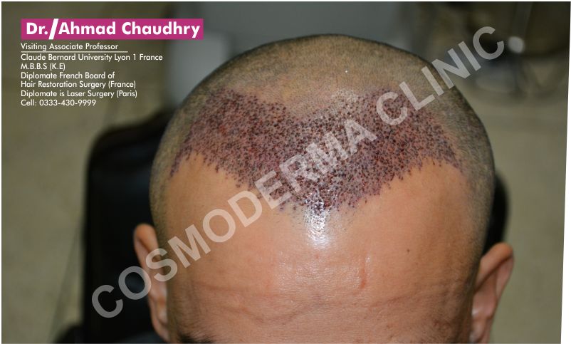 Fue hair transplant clinic khanewal