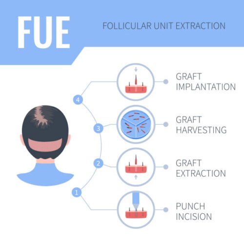 Fue procedure steps