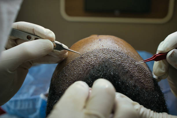 Grafts placing during hair restoration surgery
