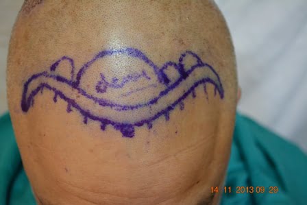 Gujranwala hair loss treatment