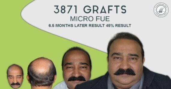 Gujranwala hair transplantation Photos