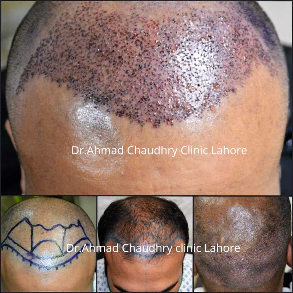 hair-transplant-in-chiniot-pakistan