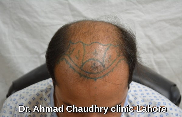 hair-transplant-in-okara