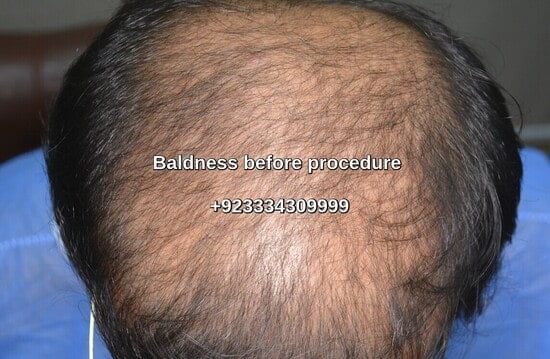 Hair loss treatment Hafizabad
