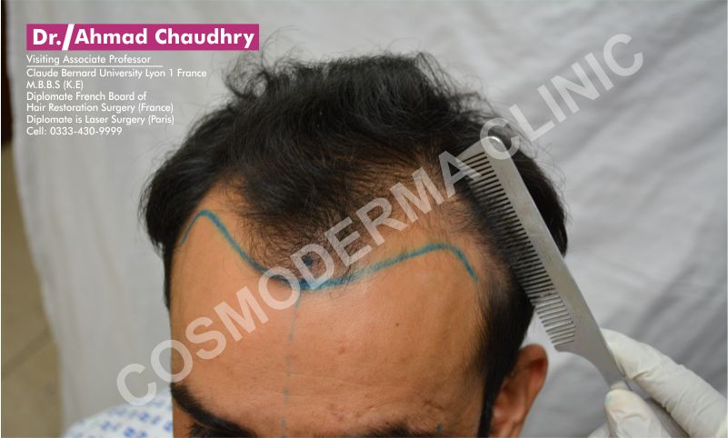 Hair loss treatment Kabirwala