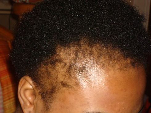 Hair loss treatment South Africa