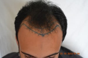 Hair transplant Dubai