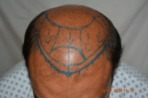 Hair transplant Germany