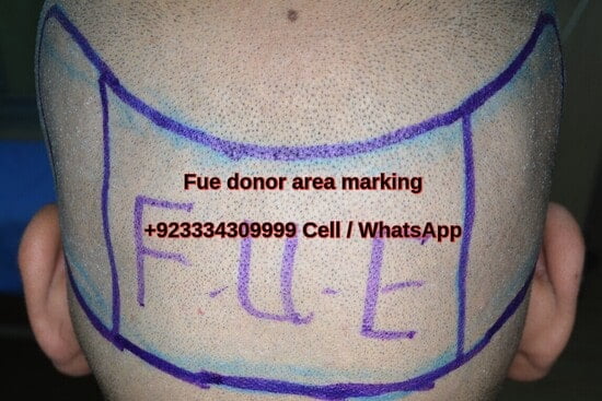 Hair transplant Hafizabad -donor area marking