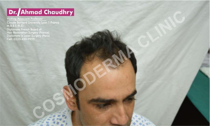 Hair transplant Khanewal