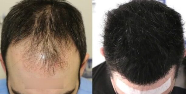 Hair transplant Pakistan before and after