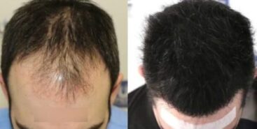 Hair transplant Pakistan before after