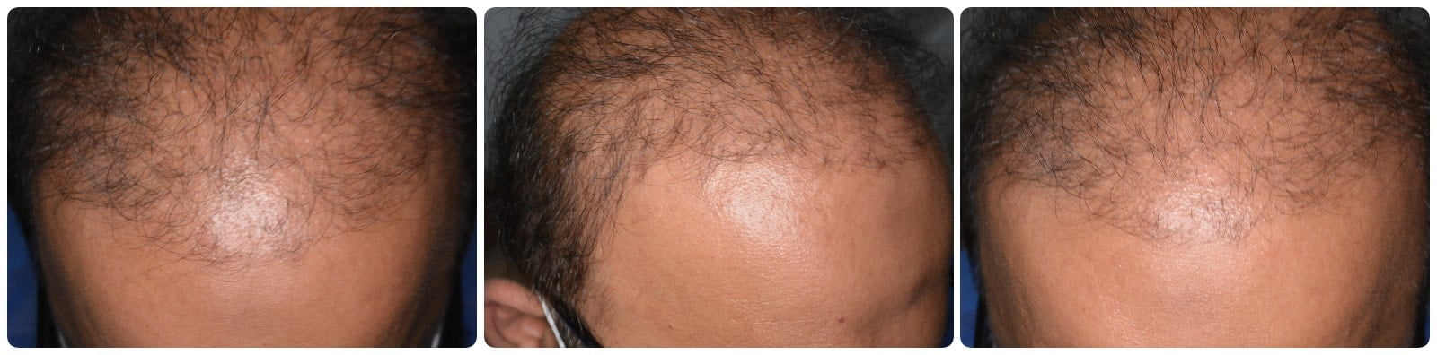 You are currently viewing Hair Transplant Mardan