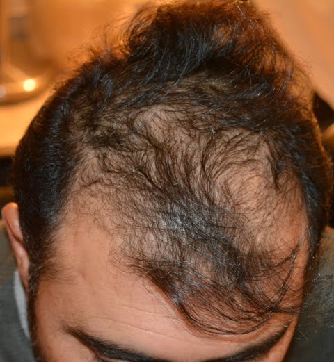 Hair transplant in Dera Ghazi Khan