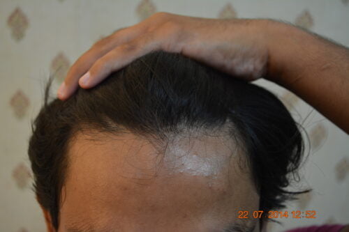 Hair transplant in Jeddah Saudi Arabia