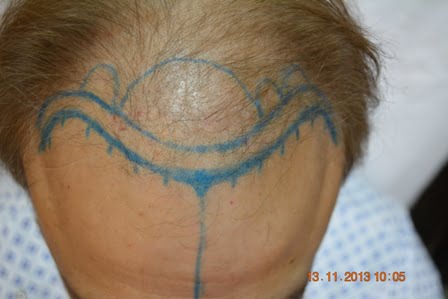 Hair transplant surgeon Gujranwala