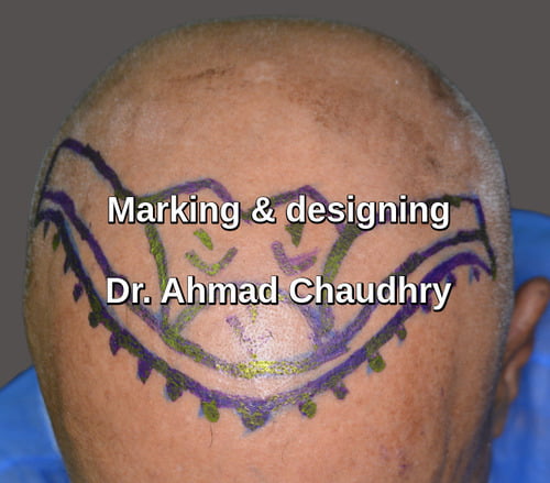 Hair transplant surgery Mashhad