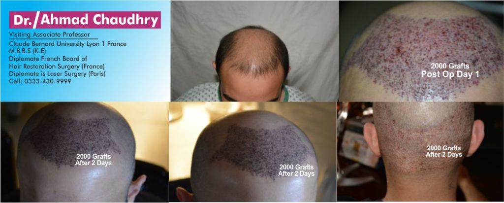 Hair transplantation surgery Pakistan