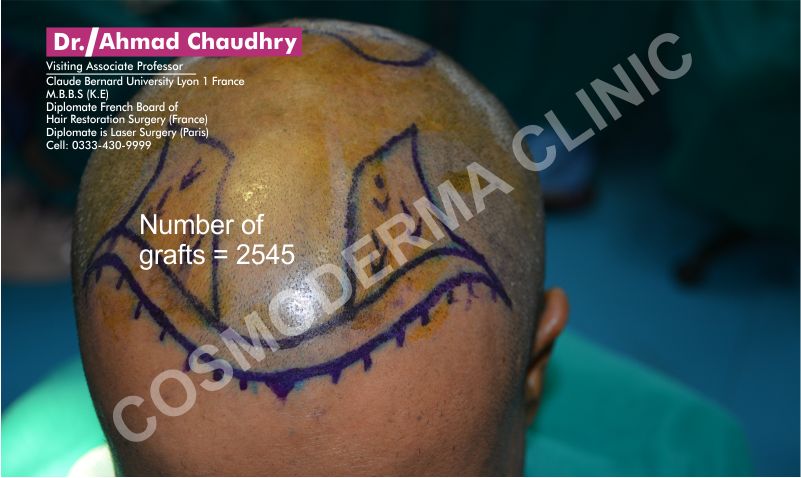 Surgical marking hair restoration Pakistan