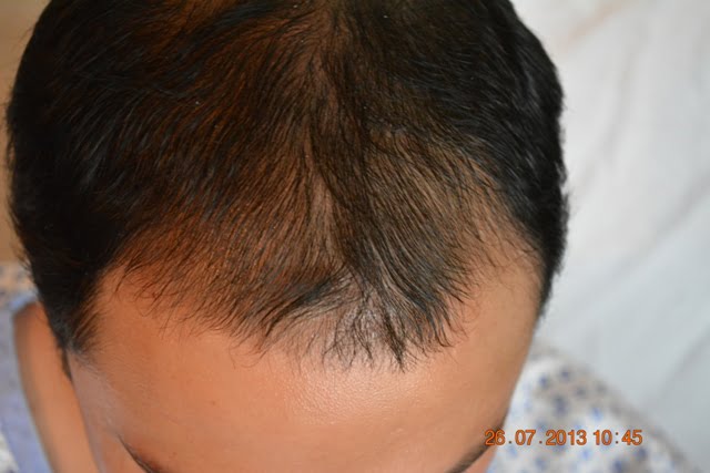 Thinning of hair treatment Dubai