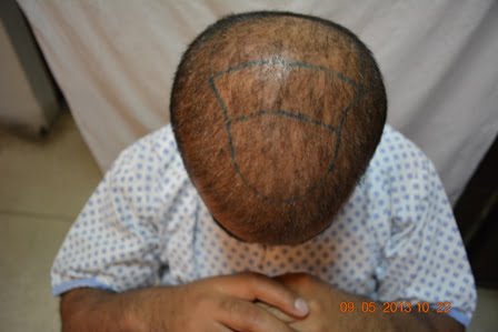 Hair transplant in Peshawar
