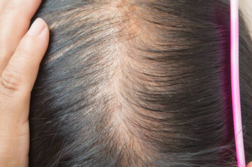 Women hair thinning