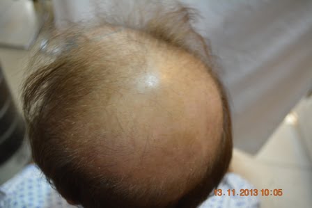baldness treatment Gujranwala
