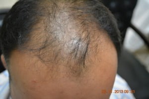 hair loss Vehari Burewala
