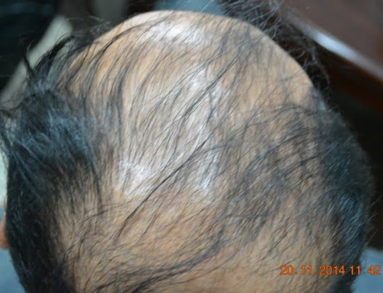 hair transplant in Kiev Ukraine