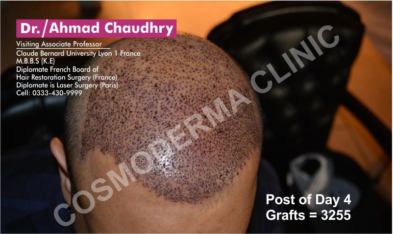 hair transplant in Sahiwal