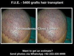 Hair transplant Arifwala