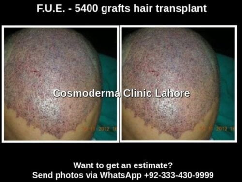 Hair transplantation in Hong Kong | $  per graft abroad | Contact us