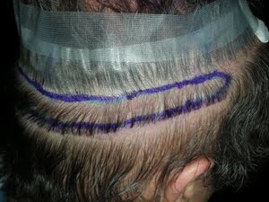 Hair transplantation Yanbu