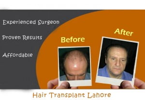 Hair Transplant Result