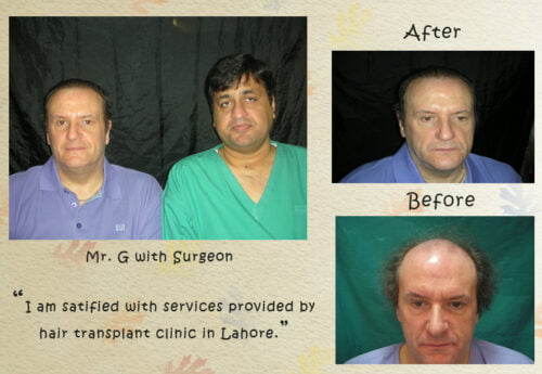 Hair transplantation Pakistan result