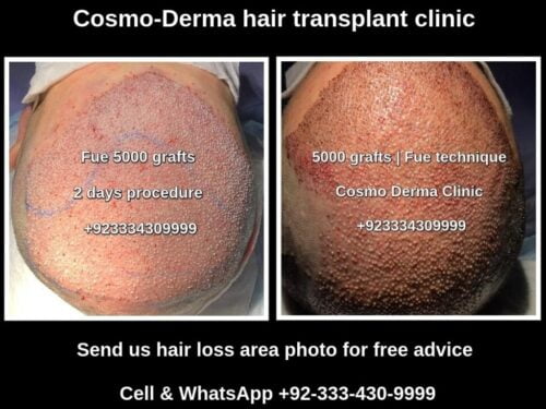 Hair transplant 5000 grafts | Single session | Fue clinic Lahore Pakistan Hair transplant 5000 grafts | Single session | Fue clinic Lahore Pakistan
